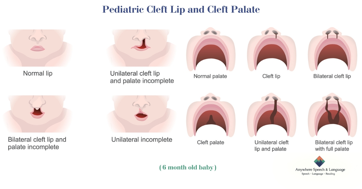 Medical Diagram of Cleft Lip and Cleft Palate in 6 month old baby | Anywhere Speech & Language Therapy | Online Speech Therapy Across The United States