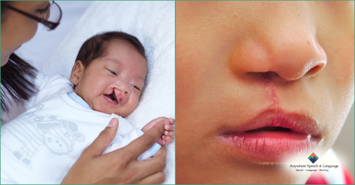 Cleft Lip and Cleft Palate Pre- and Post Operation | Anywhere Speech & Language Therapy | Online Speech Therapy Across The United States